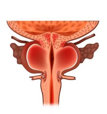 inflammation of the prostate